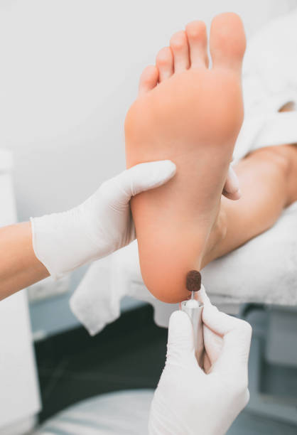 istock Chiropodist removes hardened skin on the foot, using hardware. 1142787965
