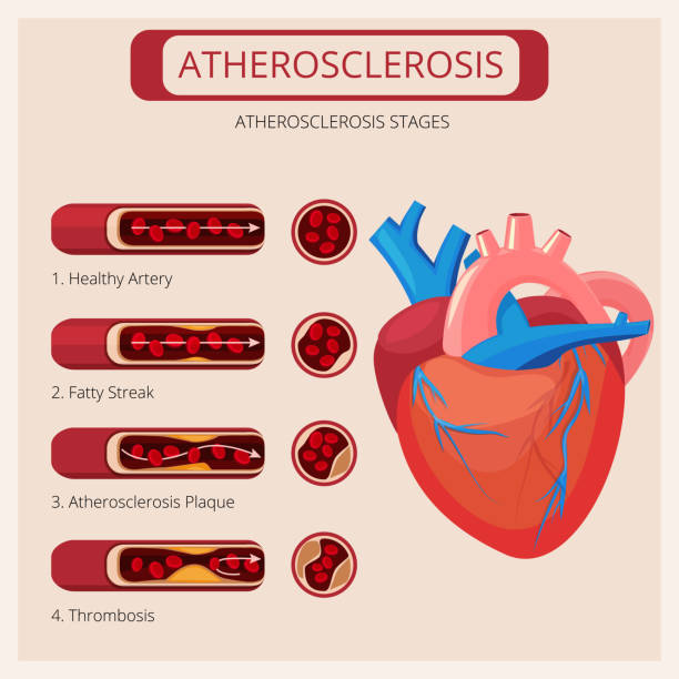 Atherosclerosis stages. Heart strokes thrombus attack blood circulatory system vector medical infographics Atherosclerosis stages. Heart strokes thrombus attack blood circulatory system vector medical infographics. Cholesterol artery, heart human and cardiovascular system illustration clogged artery stock illustrations