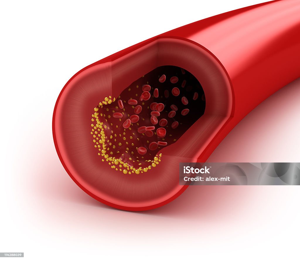 Cholesterol plaque in artery Cholesterol plaque in artery, concept isolated on white  Cross Section Stock Photo