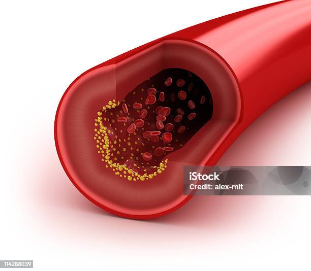 Cholesterol Plaque In Artery Stock Photo - Download Image Now - Cross Section, Cholesterol, Blood