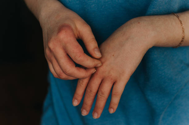 Hand allergy details. Dermatology problem stock photo