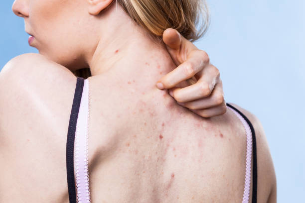 Woman with skin problem acne on back Health problem, skin diseases. Young woman showing her back with acne, red spots. Teen girl scratching her shoulder with pimples. human back stock pictures, royalty-free photos & images