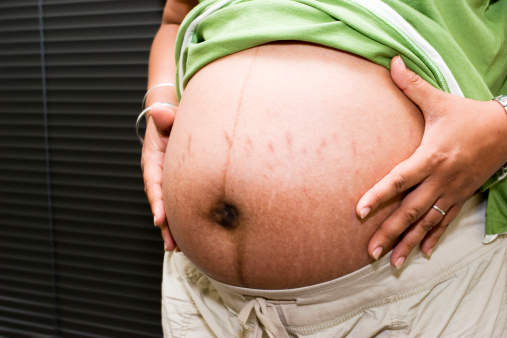 Embarazada con marcas de estiramiento photo