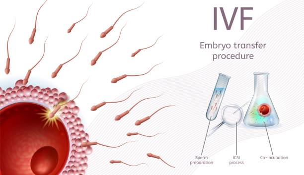 illustrazioni stock, clip art, cartoni animati e icone di tendenza di procedura di trasferimento embrionale di fecondazione in vitro. - retrieval