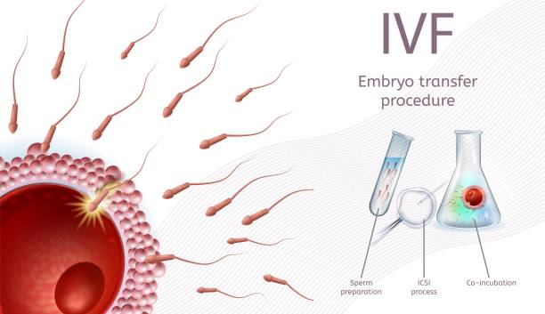 ilustrações, clipart, desenhos animados e ícones de procedimento de transferência de embriões de fertilização in vitro. - human fertility artificial insemination embryo human egg
