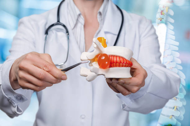 istock A doctor pointing at herniated disc with tweezers. 1143194525