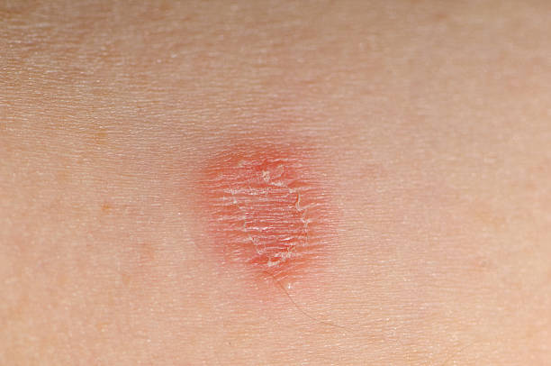Tinea corporis infection (ring worm)  ringworm photos stock pictures, royalty-free photos & images
