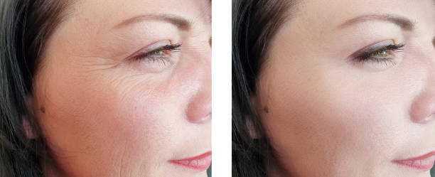 woman wrinkles face before and after procedures woman wrinkles face before and after procedures botox before and after stock pictures, royalty-free photos & images