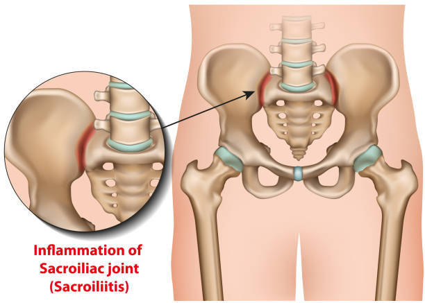 sacroiliakelie gelenkentzündung 3d medizinische vektorabbildung sacroiliitis - ischium stock-grafiken, -clipart, -cartoons und -symbole