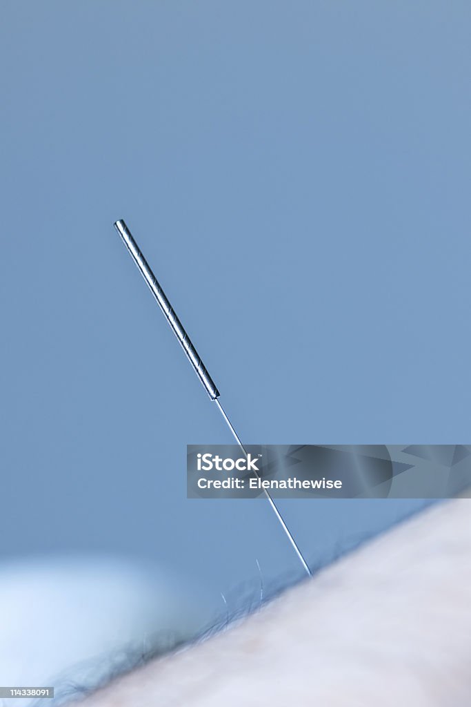 Acupuncture needle in skin  Acupuncture Stock Photo