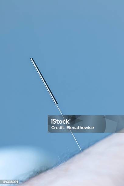 Acupuncture Needle In Skin Stock Photo - Download Image Now - Acupuncture, Acupuncture Needle, Alternative Therapy