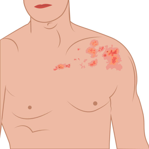 Shingles on a man body vector illustration Shingles blisters on a human body. Dermatology disease  zoster, contagious infection, red herpes spots on a human body vector illustration shingles rash stock illustrations