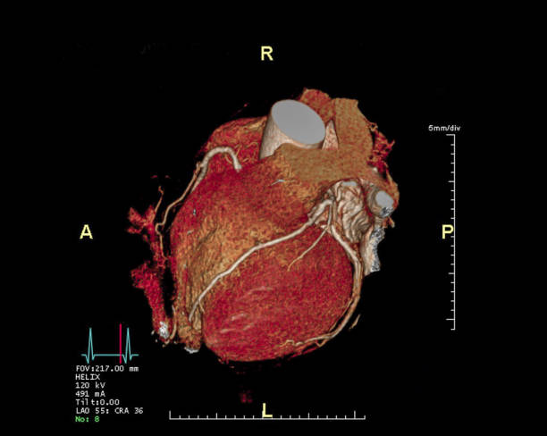 imagen de renderizado 3d de arteria coronaria cta. angiografía por tac para la enfermedad del vaso cardíaco. - computed fotografías e imágenes de stock