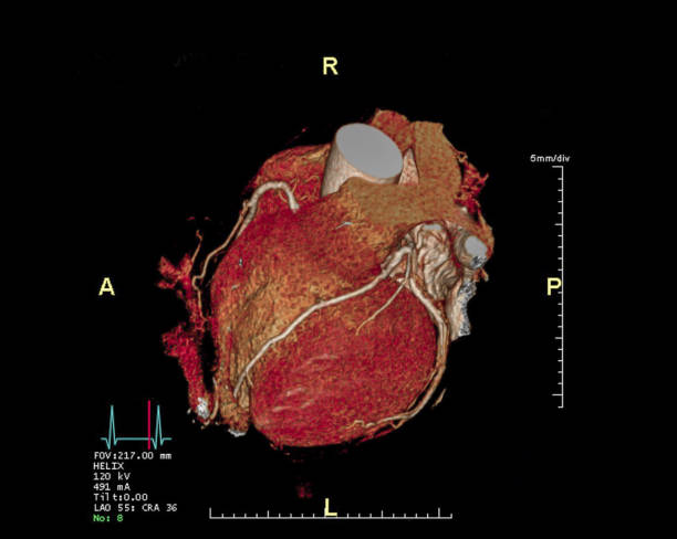 image de rendu 3d de l’artère coronaire cta. angiographie ct pour la maladie du vaisseau cardiaque. - tomographie photos et images de collection