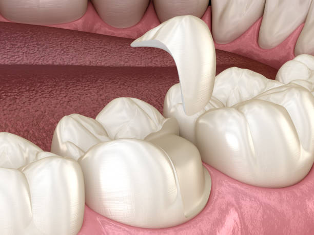 fissazione della corona in ceramica onlay sul dente. illustrazione 3d medicalmente accurata del trattamento dei denti umani - inlaid foto e immagini stock
