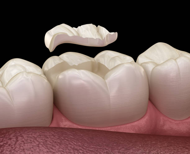 istock Inlay ceramic crown fixation over tooth. Medically accurate 3D illustration of human teeth treatment 1143554623