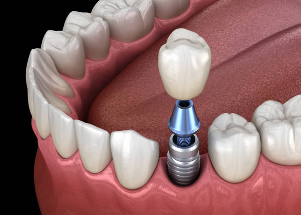 premolar tooth crown installation over implant abutment. medically accurate 3d illustration of human teeth and dentures concept - implantat imagens e fotografias de stock