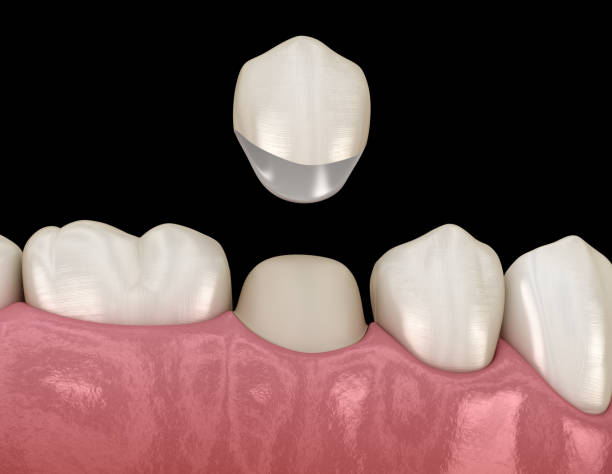 istock Preparated premolar tooth for dental crown placement. Medically accurate 3D illustration 1143554666