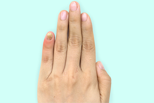 Close up of nail fungus infection on the little finger. Human hand suffering from fungus infection. Onychomycosis with fungal nail infection on nail isolated over soft background. Clipping path.