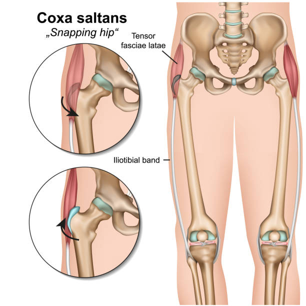 coxa saltans syndrome 3d medyczna ilustracja wektorowa na białym tle - biodro stock illustrations