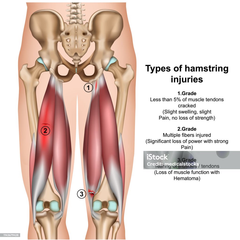 types of hamstring injurys 3d medical vector illustration on white background types of hamstring injurys 3d medical vector illustration on white background eps 10 Muscle stock vector
