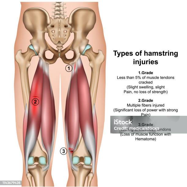 Types Of Hamstring Injurys 3d Medical Vector Illustration On White Background Stock Illustration - Download Image Now