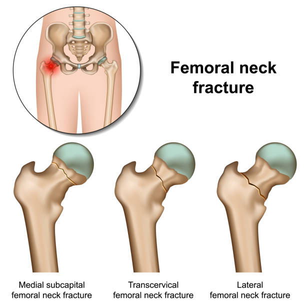 illustrations, cliparts, dessins animés et icônes de fracture du cou femoral illustration vectorielle médicale sur fond blanc - hip femur ilium pelvis
