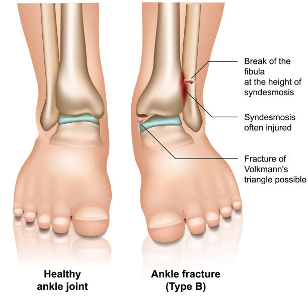 перелом голеностопного сустава тип b медицинская векторная иллюстрация на белом фоне - twisted ankle stock illustrations