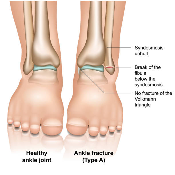 illustrazioni stock, clip art, cartoni animati e icone di tendenza di frattura dell'articolazione della caviglia illustrazione vettoriale medica di tipo a su sfondo bianco - twisted ankle immagine