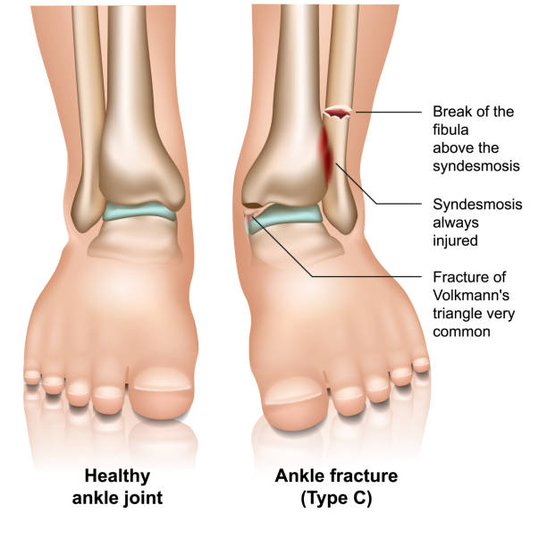 перелом голеностопного сустава тип c медицинская векторная иллюстрация на белом фоне - twisted ankle stock illustrations
