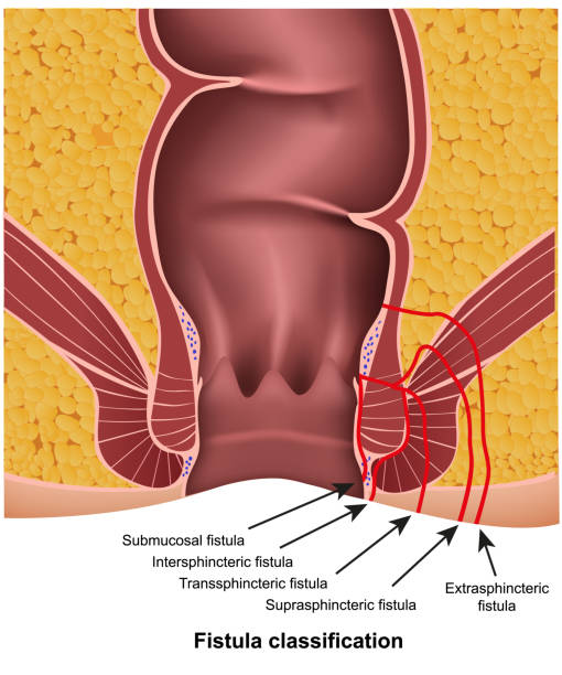 ilustrações, clipart, desenhos animados e ícones de classificações da fístula ilustração médica do vetor no fundo branco com descrição - fístula