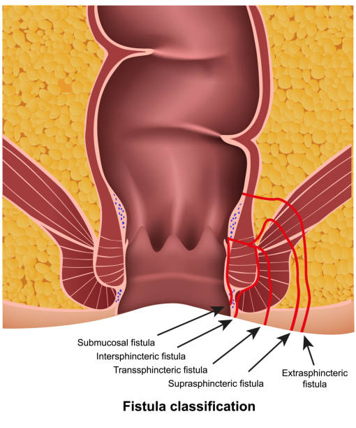 fistula classifications medical vector illustration on white background with description fistula classifications medical vector illustration on white background with description eps 10 rectum stock illustrations