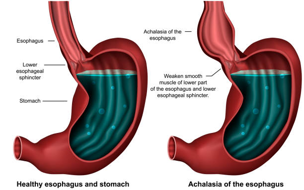 illustrazioni stock, clip art, cartoni animati e icone di tendenza di esofagea achalasia 3d illustrazione vettoriale medico su sfondo bianco - piloro