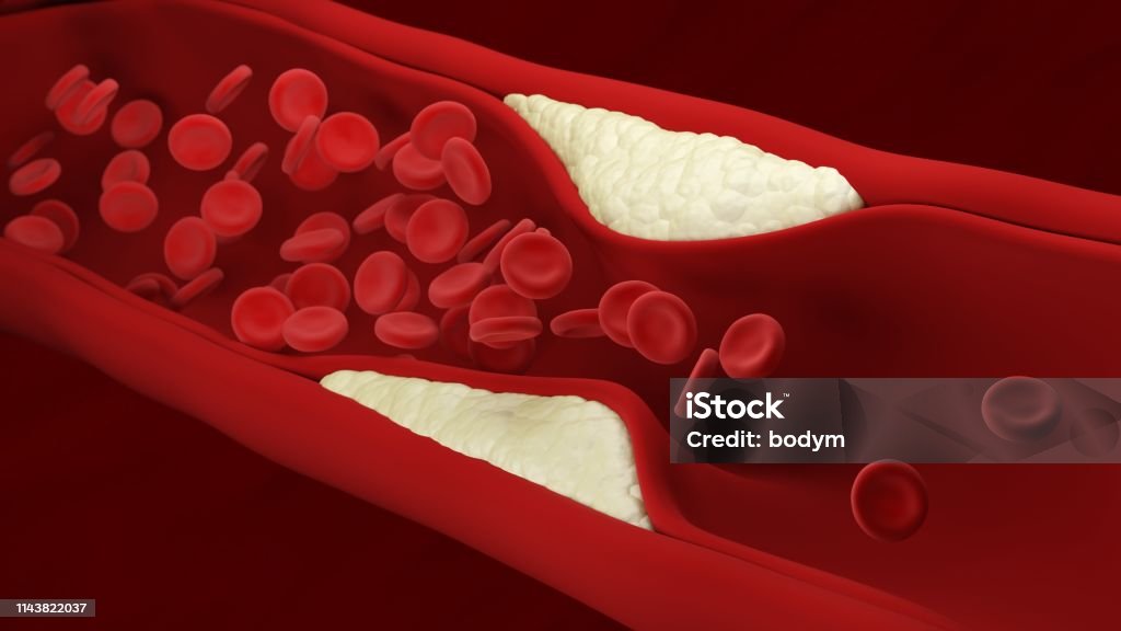 Atherosclerosis. Plaque builds up inside an artery. Blood cells. Atherosclerosis. Plaque builds up inside an artery. Blood cells. 3d illustration. Coronary Artery Stock Photo