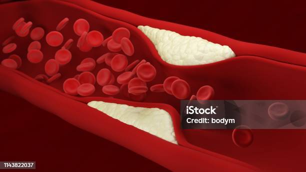 Atherosclerosis Plaque Builds Up Inside An Artery Blood Cells Stock Photo - Download Image Now