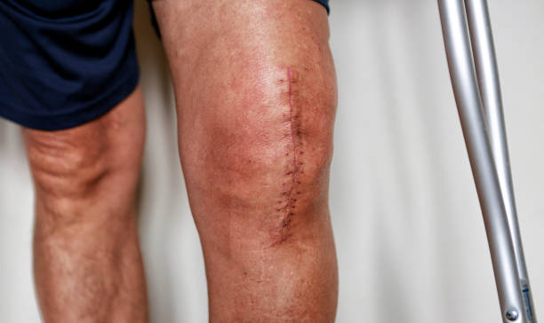 schmerzhafte narbe nach knieoperation - scar stock-fotos und bilder