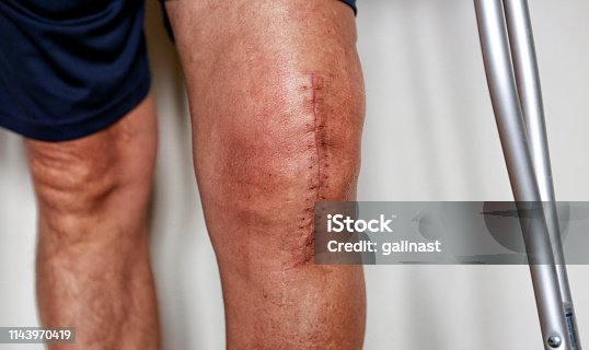 4,500+ Scar On Leg Stock Photos, Pictures & Royalty-Free Images - iStock