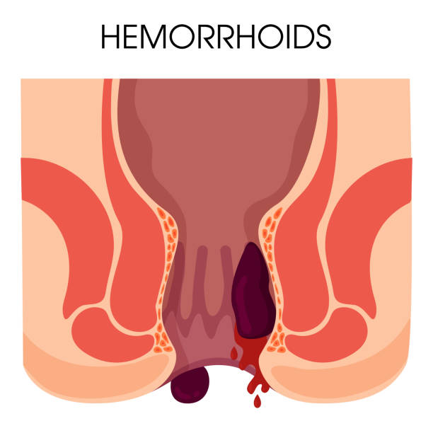 hemoroidy i stany zapalne powodują krwawienie przez przetokę pacjenta. - hemorrhoid stock illustrations