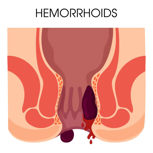 ilustrações de stock, clip art, desenhos animados e ícones de hemorrhoids and inflammation cause bleeding through the fistula of the patient. - hemorrhoid