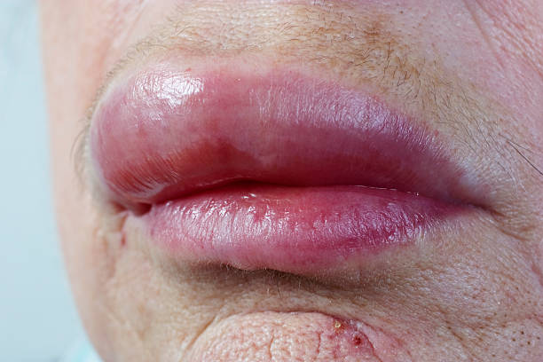 lip allergy stock photo