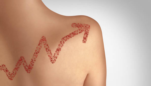 Increase In Measles Cases Increase in measles concept as a rising deadly outbreak disease and viral illness as a contagious chickenpox or a skin rash in a 3D illustration style. measles stock pictures, royalty-free photos & images