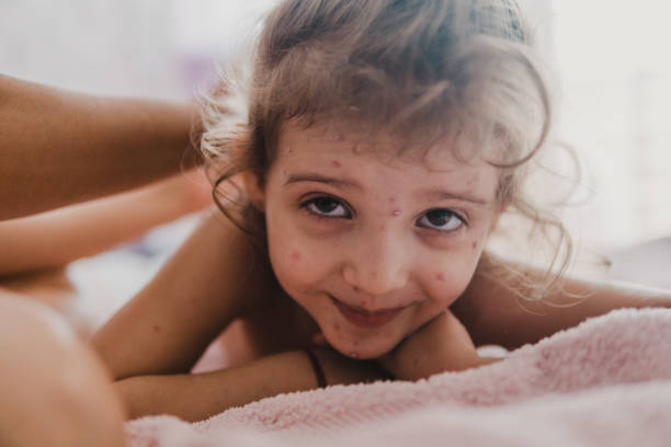 istock Little girl with Chickenpox 1144289717
