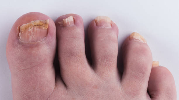 istock Nail fungus on legs. Close-up on a white background. 1144385570