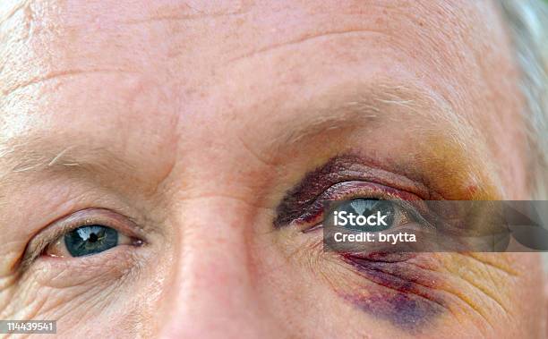 Caucásica Senior Hombre Con Hiere Más Profundamente Ojo Mirando A La Cámara Foto de stock y más banco de imágenes de Ojo morado