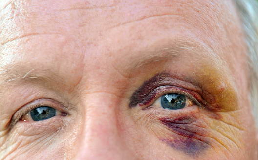 Caucasian senior  man with a bruised eye looking at camera.