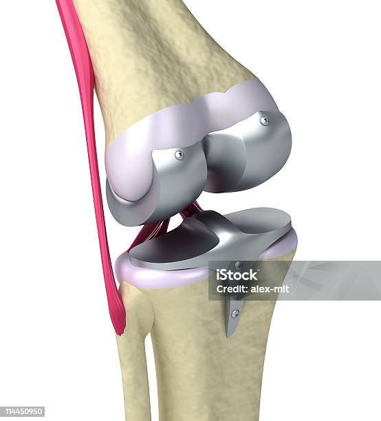 フルニーチタン蝶番関節 - 人工膝関節のストックフォトや画像を多数ご用意 - 人工膝関節, イラストレーション, 人工関節