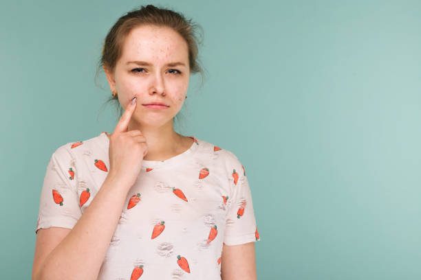 porträt von teenager-mädchen, die ihr gesicht berühren und nach akne suchen - akne stock-fotos und bilder