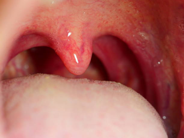 tonsilite infezione gola ha aperto bocca gola tonsille - ugola foto e immagini stock