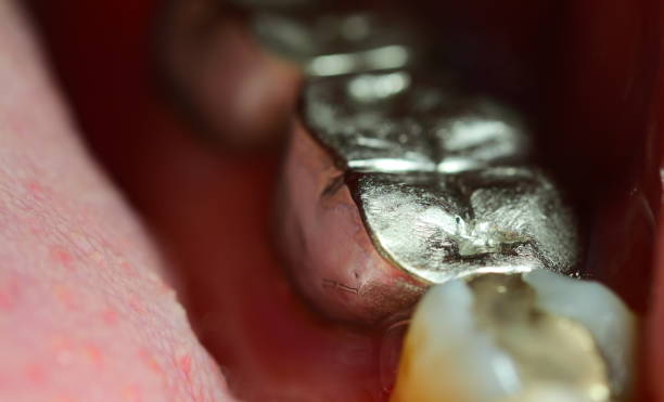 istock Teeth with different types of dental filling 1144603039