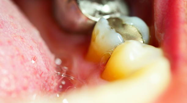 istock Fissure dental fillings, Medically accurate 1144603058